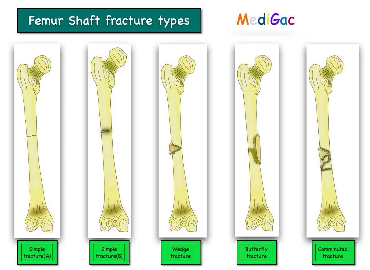 Femur shaft fractures types